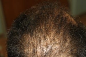 hair 5 months after prp scalp treatment series (1)