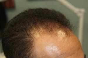 hair 5 months after prp scalp treatment series (2)