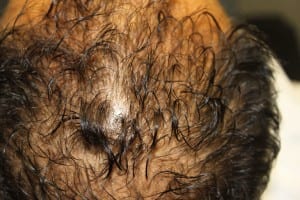 hair before any prp scalp treatment (1)