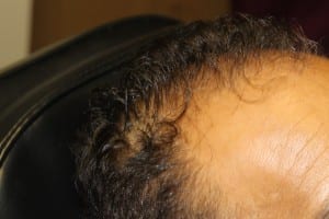 hair before any prp scalp treatment (2)